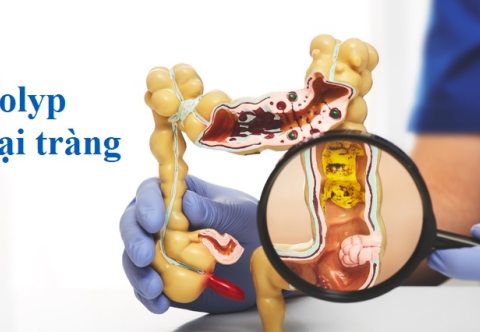 Nguyên nhân gây ra polyp đại tràng là gì?